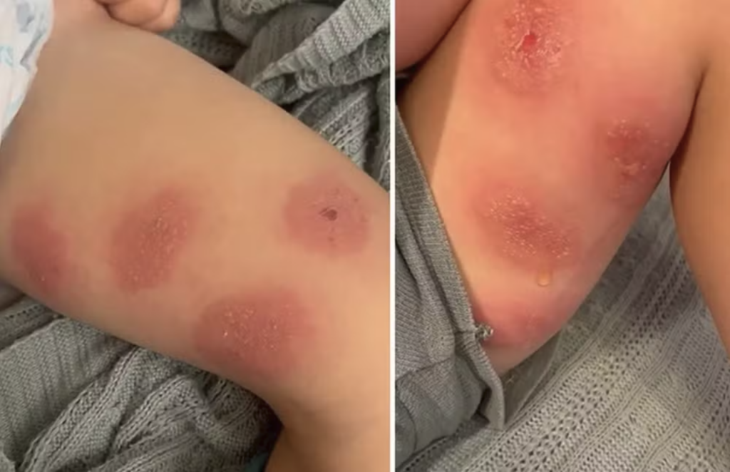 Alergia à insetos